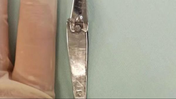 Щипцы для стрижки ногтей вытащили из желудка шестилетнего мальчика в Уфе