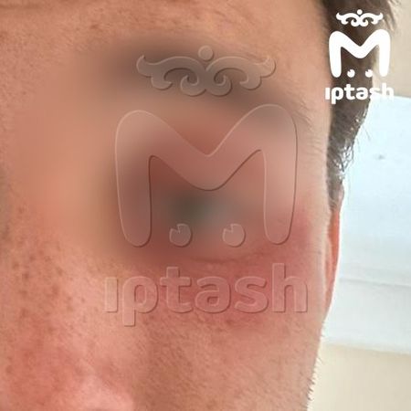 В Казани парень получил химический ожог глаза после нападения водителя «Мазды»