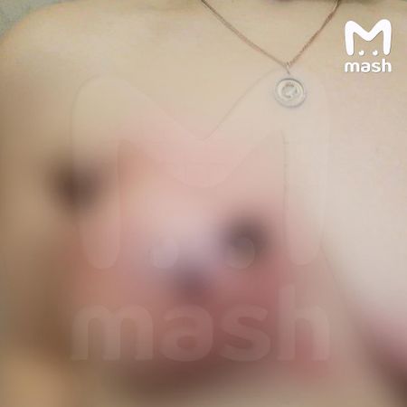 Жительница Тулы год прожила с салфеткой, которую хирург забыл в груди во время операции